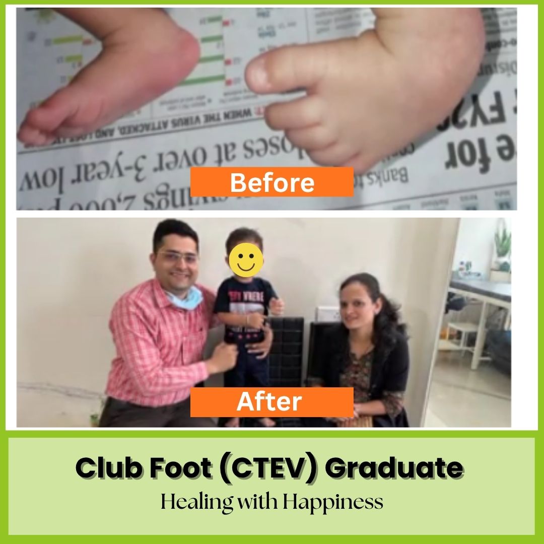 The success story of another club foot (CTEV) graduate