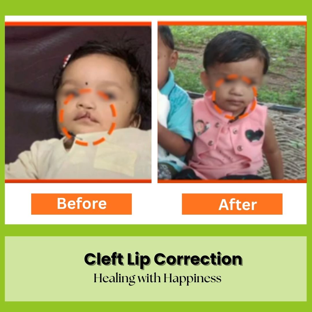 Cleft Lip Correction