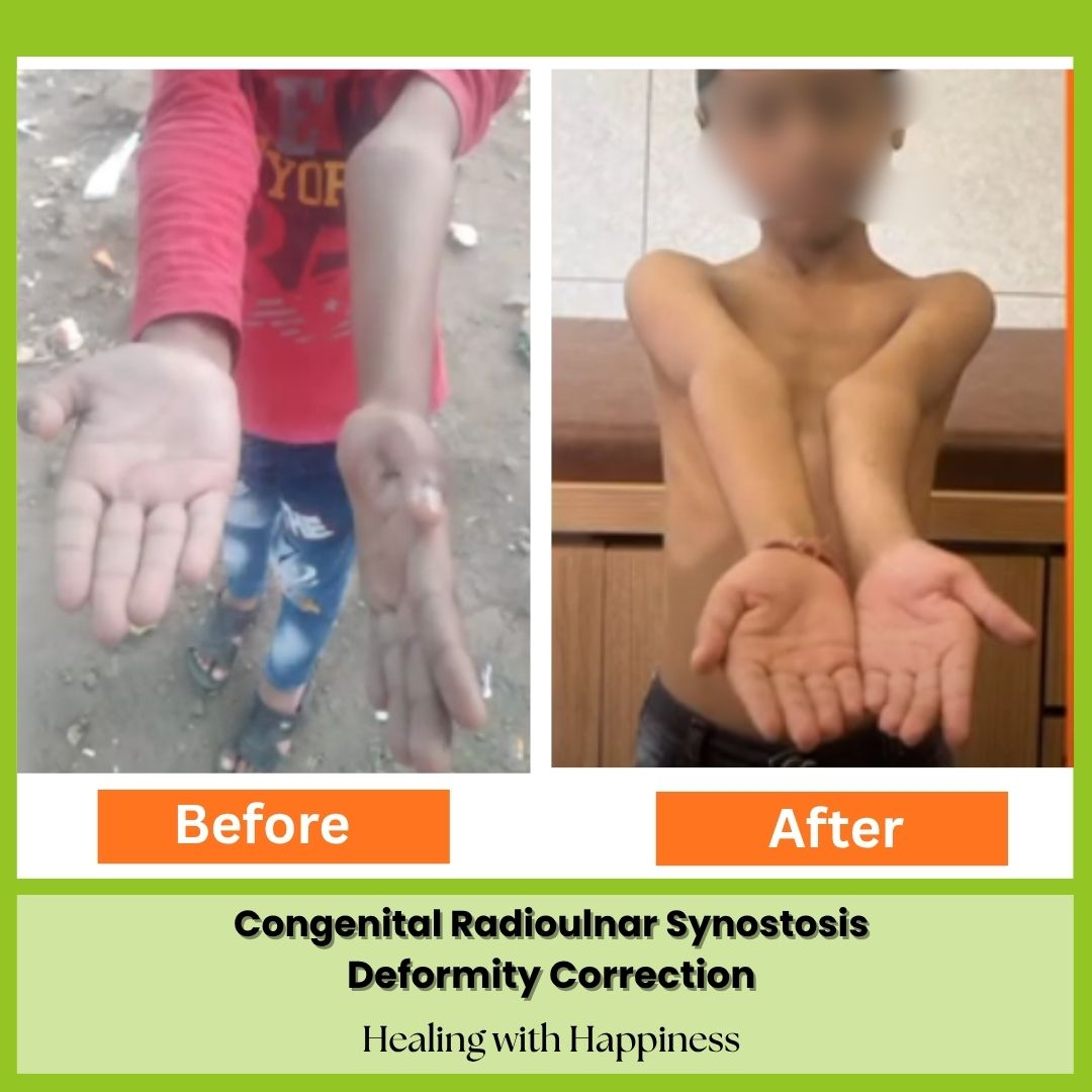 Deformity Correction Surgery for Congenital Radioulnar Synostosis