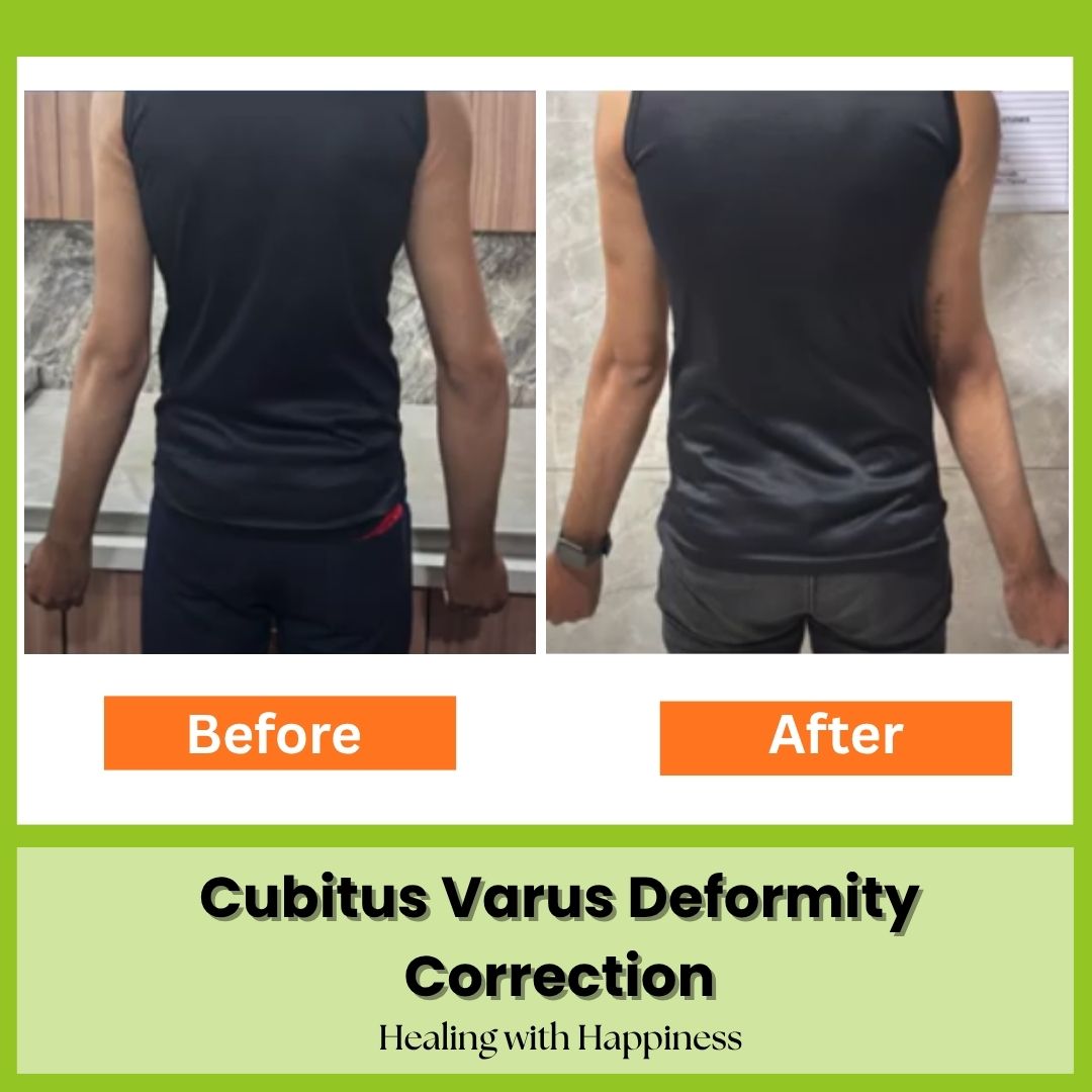 Cubitus Varus deformity correction | Dr. Rajeev Nirawane | Orange Health Care